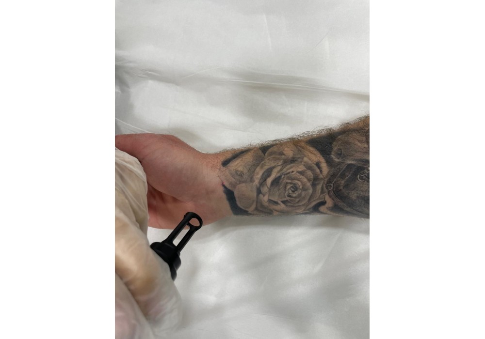 Eliminación de Tatuaje Grande | Laser Esthetic