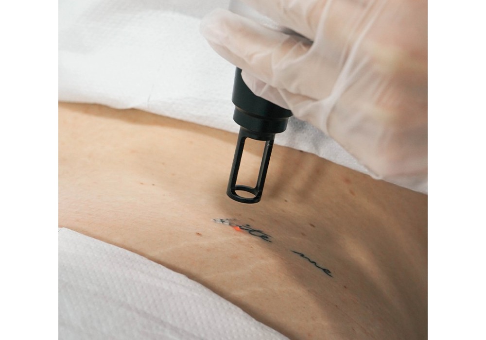 Eliminación Tatuaje Pequeño | Laser Esthetic