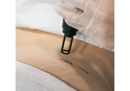 Eliminación Tatuaje Pequeño | Laser Esthetic