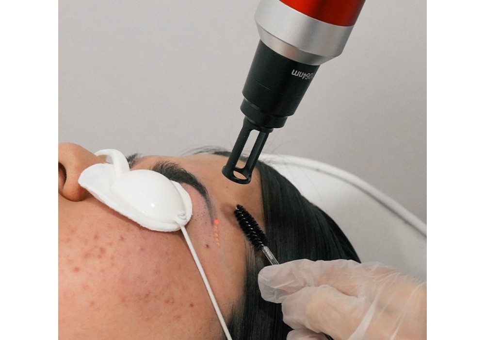 Eliminación de Micropigmentación | Laser Esthetic