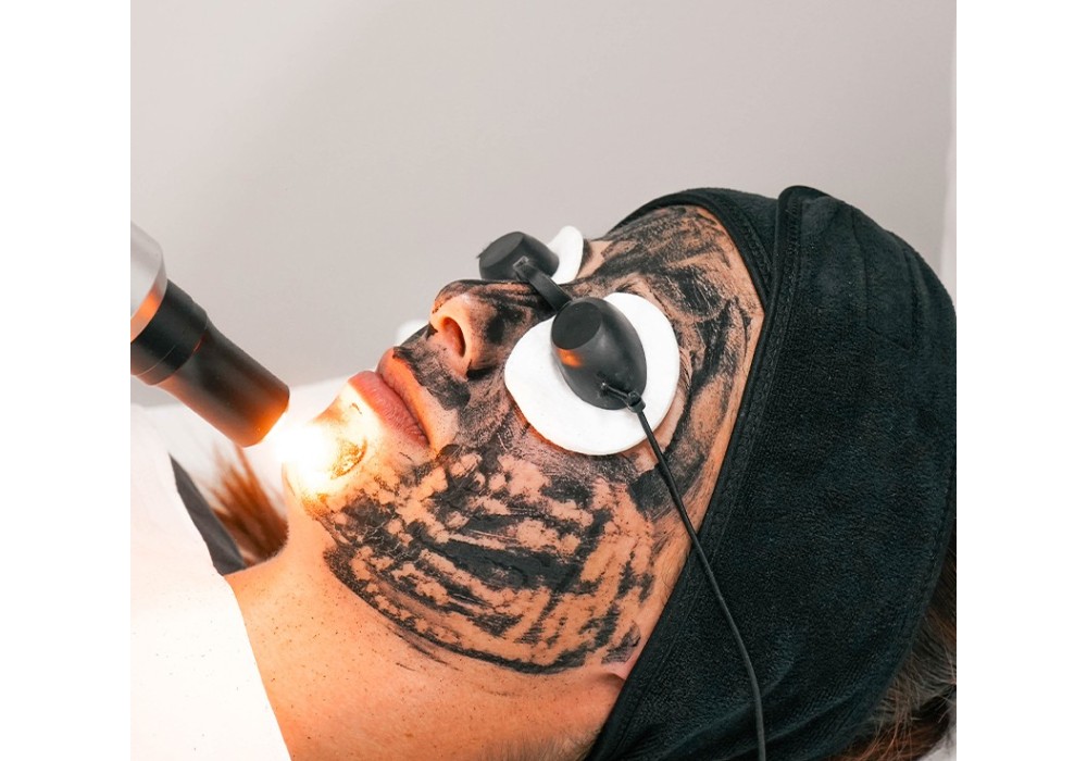 Peeling Hollywood Carbón - Bono 3 Sesiones + 1 Regalo | Laser Esthetic