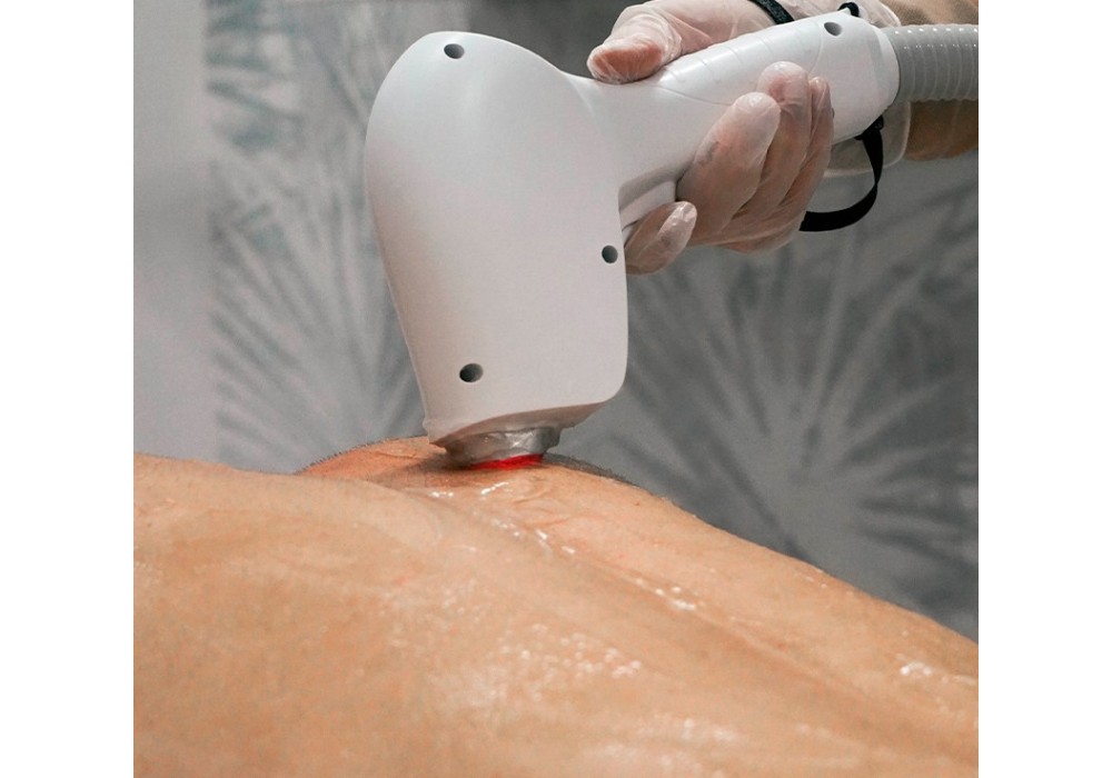 Depilación Láser por Sesiones - Zonas Grandes | Laser Esthetic