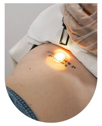 Eliminación de tatuajes